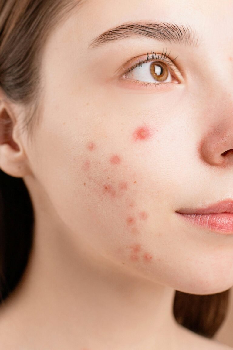 How to Prevent and Treat Acne Naturally in 2025